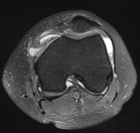 MPFL Femoral Tear